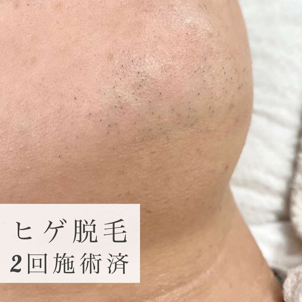【写真有り】ヒゲ脱毛２回照射済み　　〔浜松市　おすすめ〕