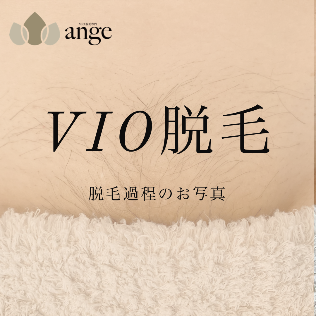VIO脱毛過程のお写真📷　〔vio脱毛　浜松〕